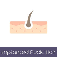 Implanted Pubic Hair (+$135 AUD)